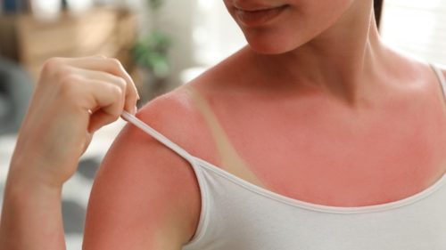 Sunburns: How to Reduce the Chances of Getting Them, And How to Deal With